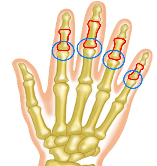 中節骨基部裂離骨折 つき指と思っていたら 骨折だった 古東整形外科 リウマチ科