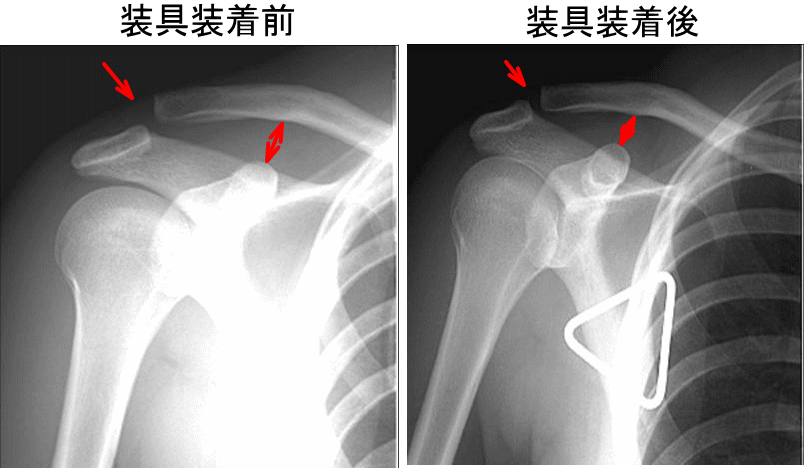 肩鎖関節脱臼（肩鎖関節脱臼を手術をしないで治すには？） - 古東整形