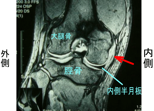 膝の内側側副靭帯損傷 膝の内側が痛い 古東整形外科 リウマチ科