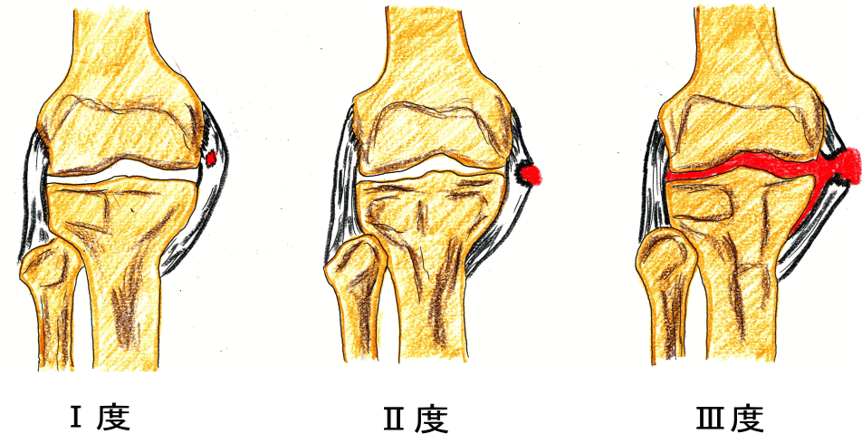 膝の内側側副靭帯損傷 膝の内側が痛い 古東整形外科 リウマチ科