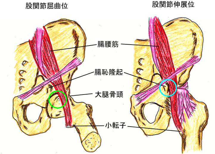 腸腰筋滑液包炎の治療