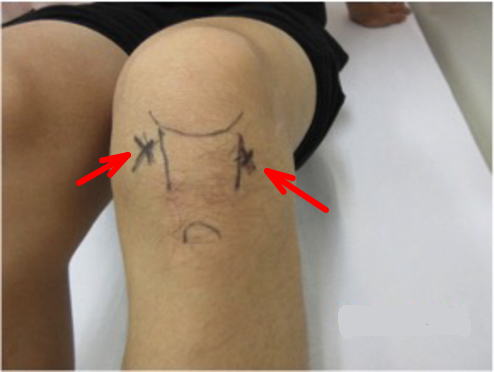 Hoffa病 膝蓋下脂肪体炎 膝の曲げ伸ばしを繰り返すと 膝の前面が痛い 古東整形外科 リウマチ科