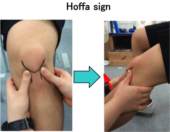 Hoffa病 膝蓋下脂肪体炎 膝の曲げ伸ばしを繰り返すと 膝の前面が痛い 古東整形外科 リウマチ科