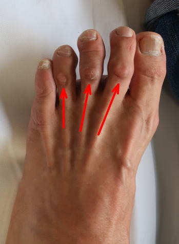 足趾 足指 の変形 ハンマー足趾 鉤爪趾 槌趾 足趾の変形で 靴が当たって痛い 古東整形外科 リウマチ科