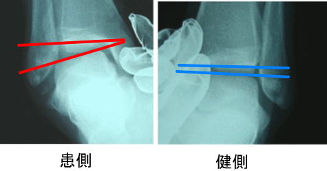 足関節前方インピンジメント症候群 足首の前が詰まってしゃがめない 古東整形外科 リウマチ科