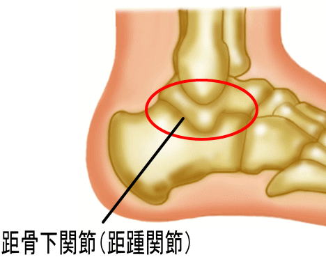 変形性距骨下関節症・変形性距踵関節症（走ったり、登山をすると踵の奥が痛い！） | 古東整形外科・リウマチ科