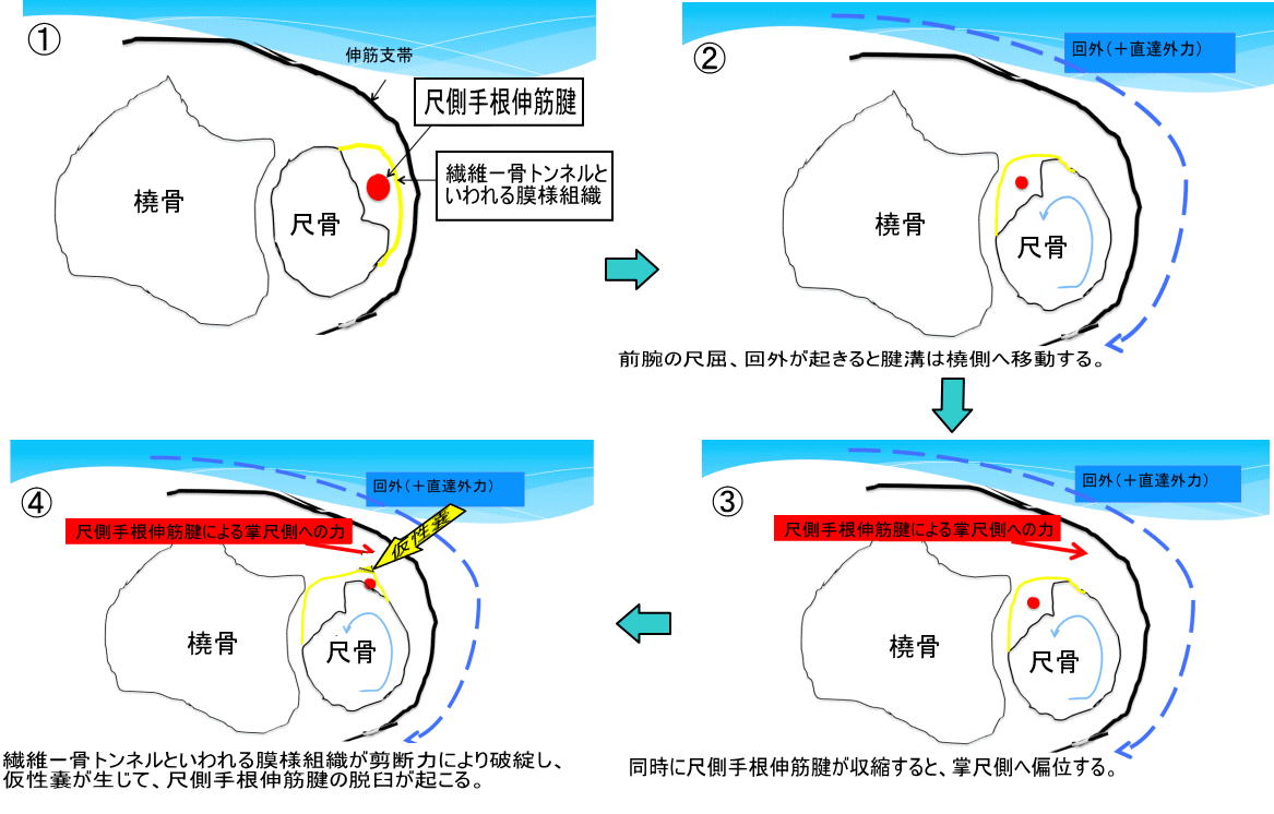 尺側手根伸筋腱脱臼 小指側の手首がカクカクする 古東整形外科 リウマチ科