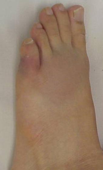 足の指が打撲で歩くと痛いですか? | 足の指 チクッと痛い | 足指の骨折の見分け方 – IJYSSS