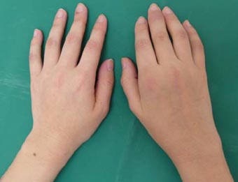 乾癬性関節炎発疹の治療選択肢