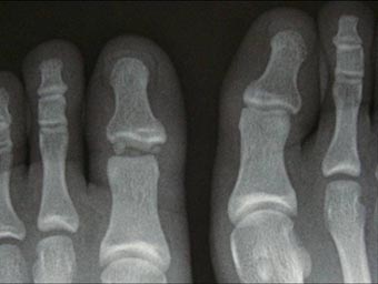 足趾の骨折 足の趾の打撲だと思っていたら 骨折だった 古東整形外科 リウマチ科