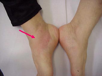 足にみられる石灰沈着性腱炎 足関節石灰沈着性腱炎 古東整形外科 リウマチ科