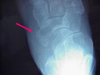 足にみられる石灰沈着性腱炎 足関節石灰沈着性腱炎 古東整形外科 リウマチ科