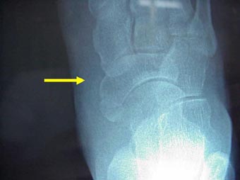 足にみられる石灰沈着性腱炎 足関節石灰沈着性腱炎 古東整形外科 リウマチ科