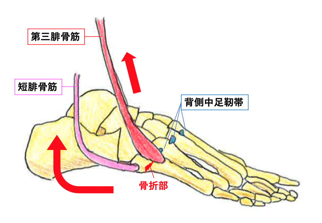 第5中足骨基部骨折 Jones骨折 外傷性および疲労性骨折が難治性である理由 古東整形外科 リウマチ科