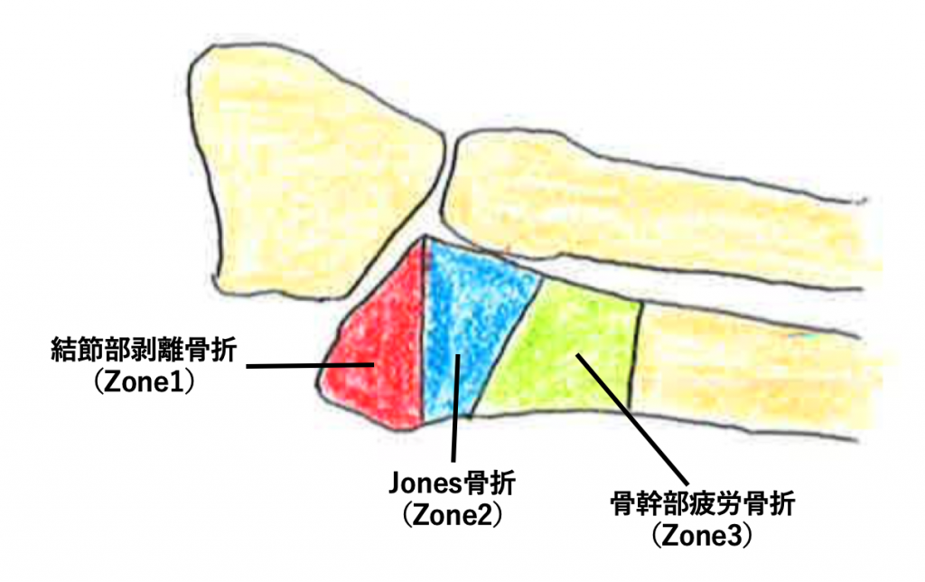 第5中足骨骨折の治療