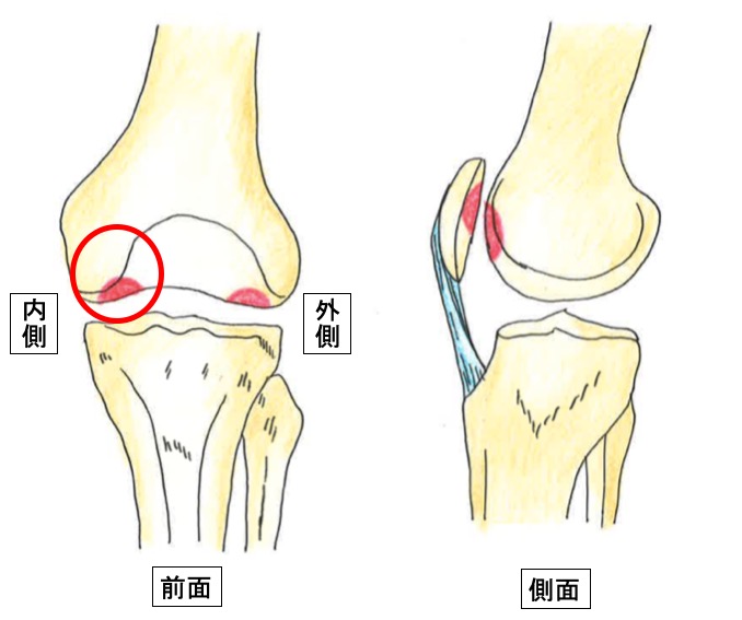 膝離断性骨軟骨炎 スポーツ中に膝がガクっとなるのは なぜ 古東整形外科 リウマチ科