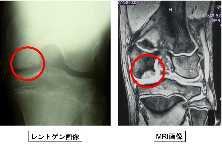 膝離断性骨軟骨炎（スポーツ中に膝がガクっとなるのは、なぜ？） 古東整形外科・リウマチ科