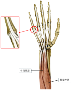 非外傷性伸筋腱脱臼 - 古東整形外科・リウマチ科